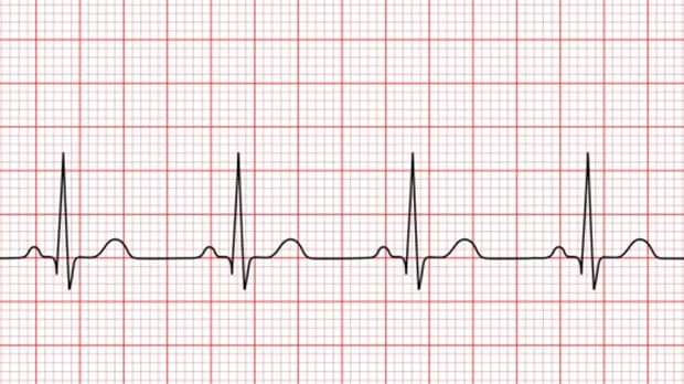 ECG
