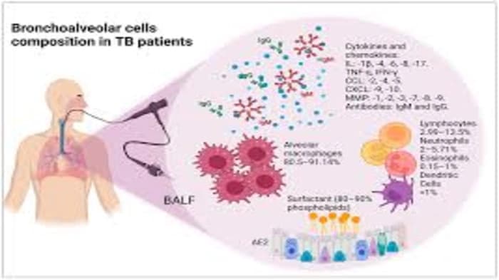 New technique for identifying TB DNA in exhaled air